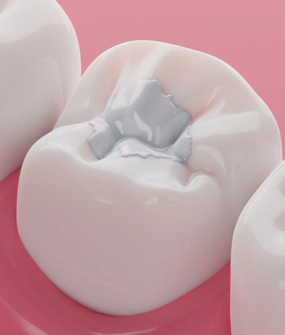 Treating Cavities with Fillings That Look like Your Teeth