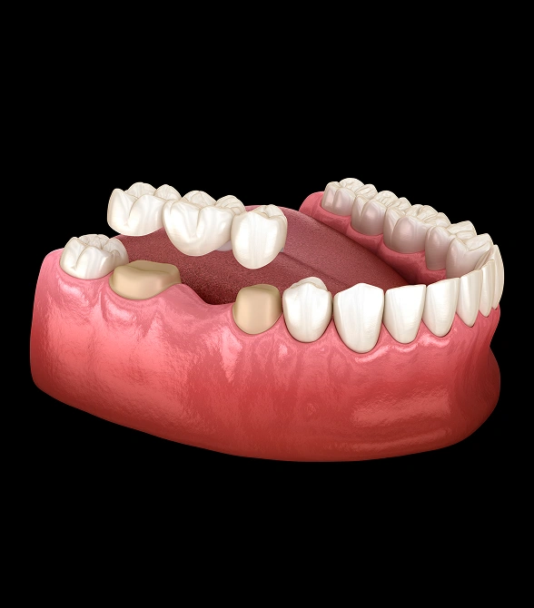 A Fixed Solution for a Missing Tooth