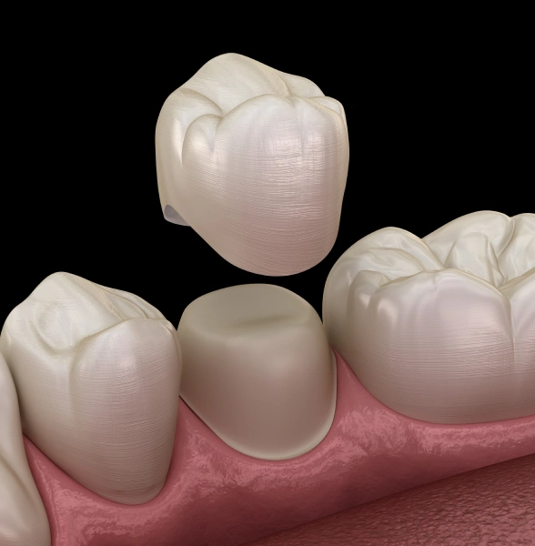 When a Filling Is Not Enough to Save a Tooth