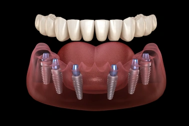 Full Arch Fixed Implant Restoration.
