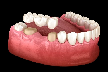 Dental Implants Implant Supported Bridge