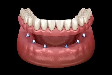 Dental Implants Implant Supported Full Denture