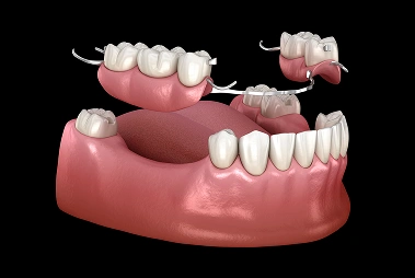 Implant Supported Partial Denture