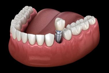 Single Tooth Implant