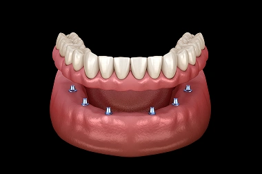 Dental Implants Supported Dentures